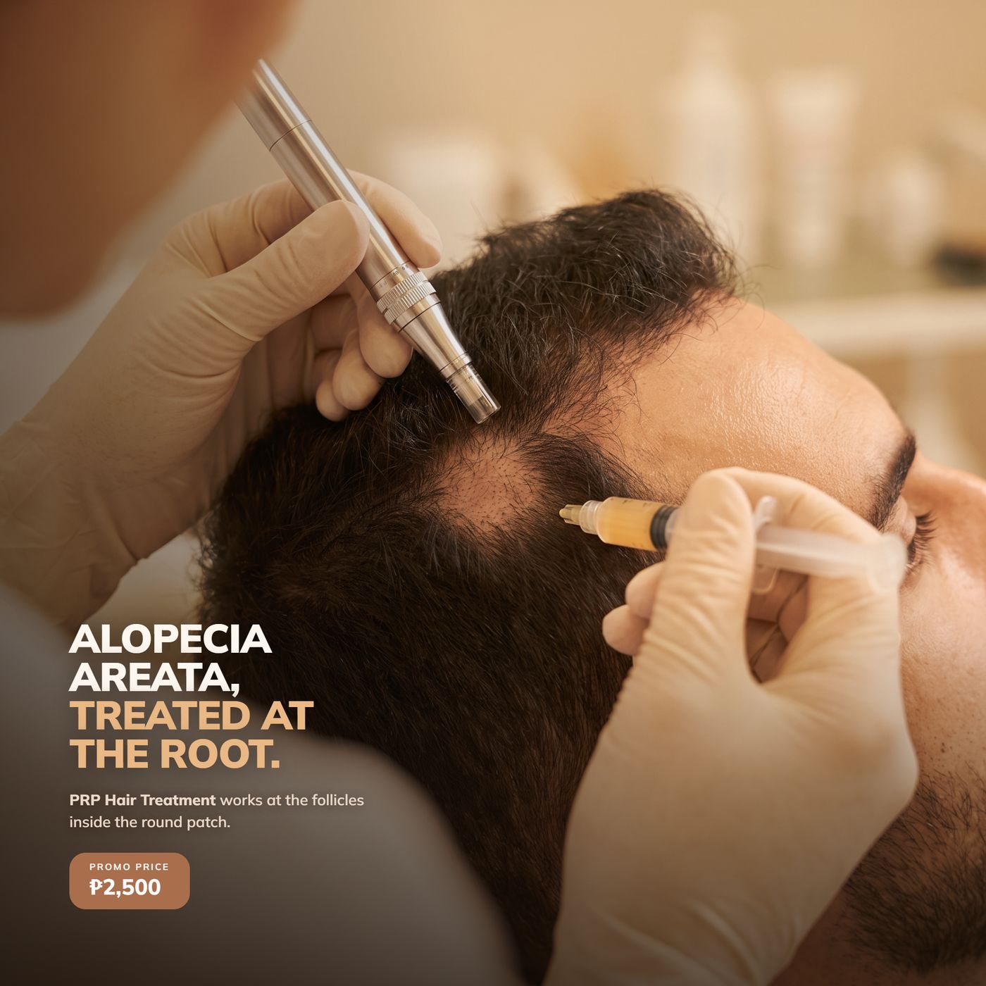 Roots & Co PRP ad — alopecia